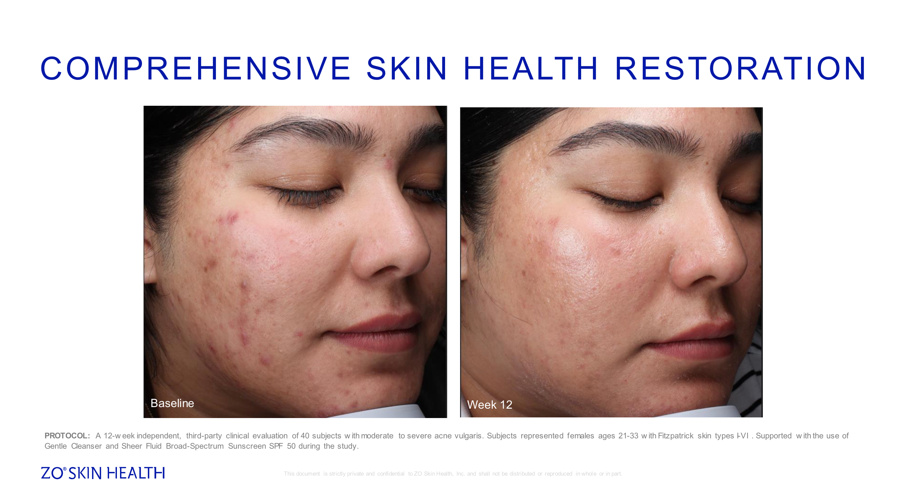 ZO Skin Health Acne Complex